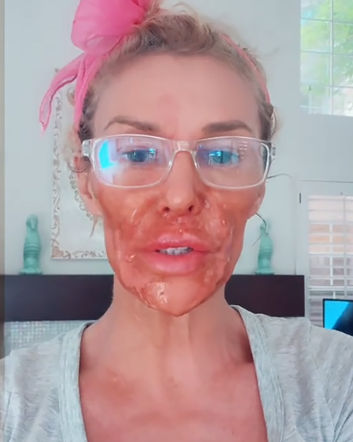 Brandi Glanville with chemical burn on face, attempting to remove parasite, wearing glasses and a pink headband indoors.
