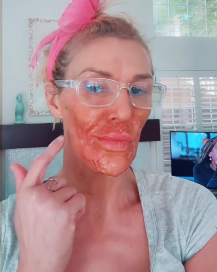 Brandi Glanville with chemical burn on face applying treatment in attempt to remove parasite, wearing glasses and pink headband.
