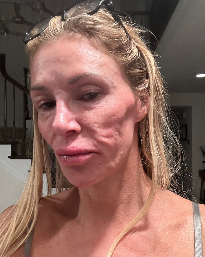 Brandi Glanville with chemical burns on her face showing skin damage while trying to remove parasite symptoms.