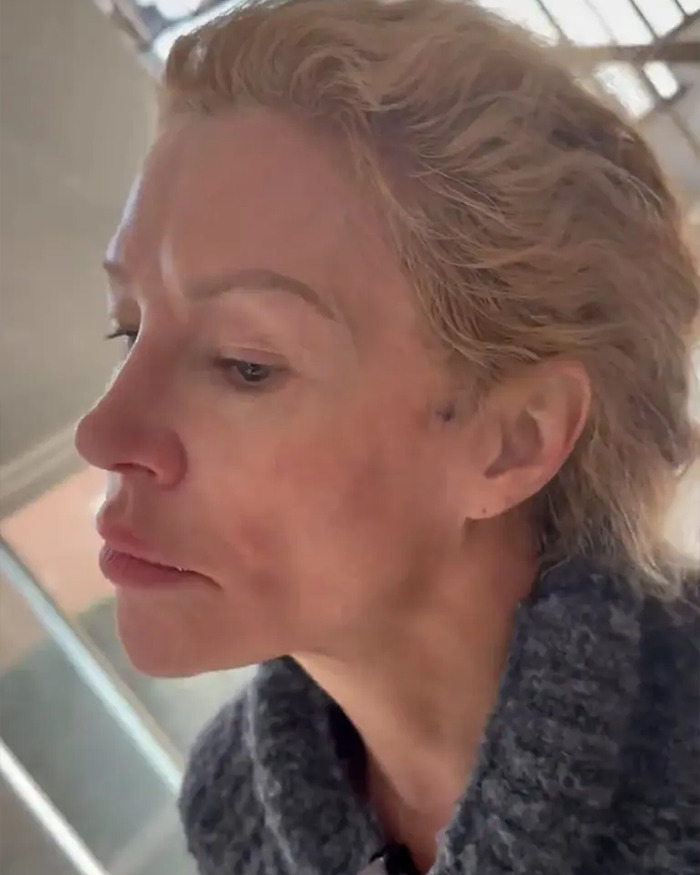 Brandi Glanville showing chemical burns on her face trying to remove a parasite with visible skin irritation and redness.