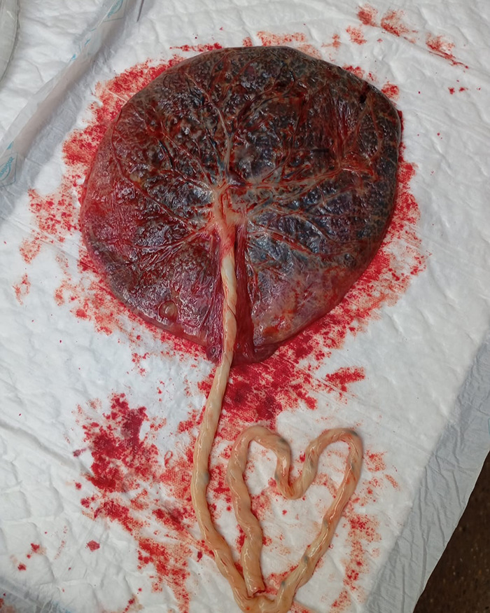 Placenta and umbilical cord arranged on a white surface, related to Calvin Harris placenta encapsulation process. - 4