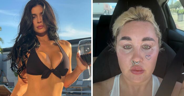 “Love The Lips”: Amanda Bynes Shocks Fans With Transformation After Revealing New Cosmetic Procedures