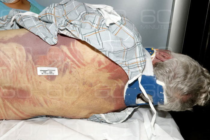Epstein lying on hospital bed with neck brace showing body injuries amid missing minutes in jail video doubts. - 6