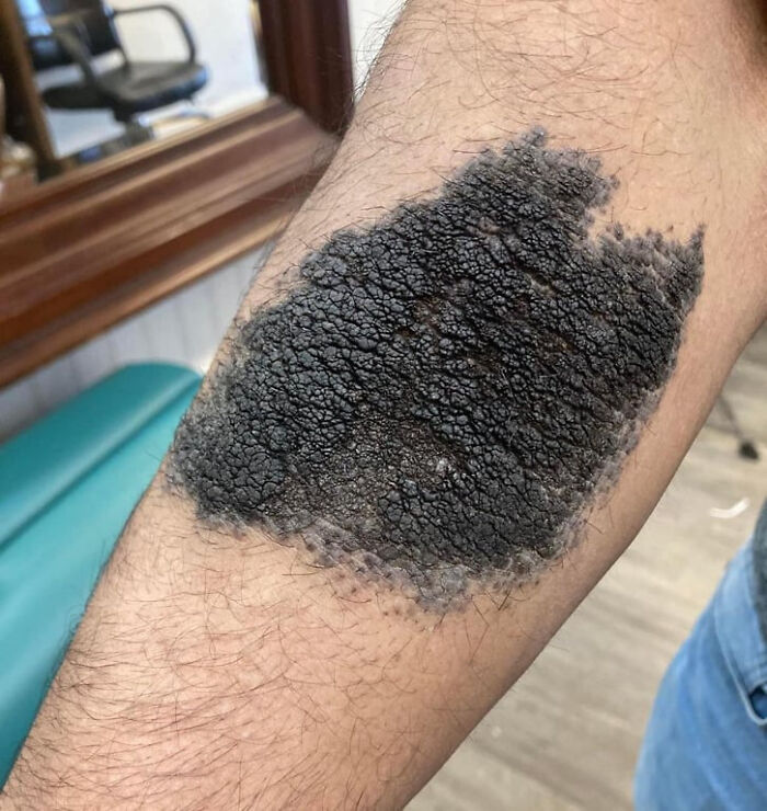 Close-up of a human arm showing a large, dark, c*****d patch of skin as a fascinating wild human body phenomenon.