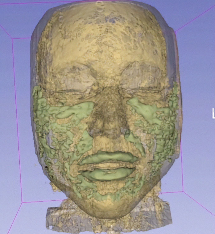 3D scan of a face showing uneven textures, related to Love Island face trend and filler blindness concerns.