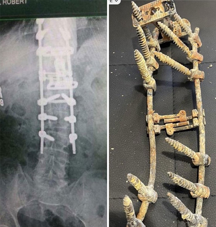 X-ray and rusty metal frame with large screws showing unsettling medical hardware from morbid knowledge group.