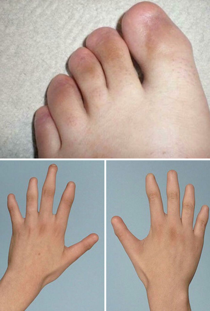 Pie de foto con rasgos distintivos del cuerpo humano en manos y pie con dedos anormales visibles.