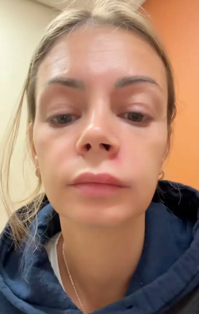 Mom Ends Up in Urgent Care After Popping Pimple In The “Triangle Of Death”