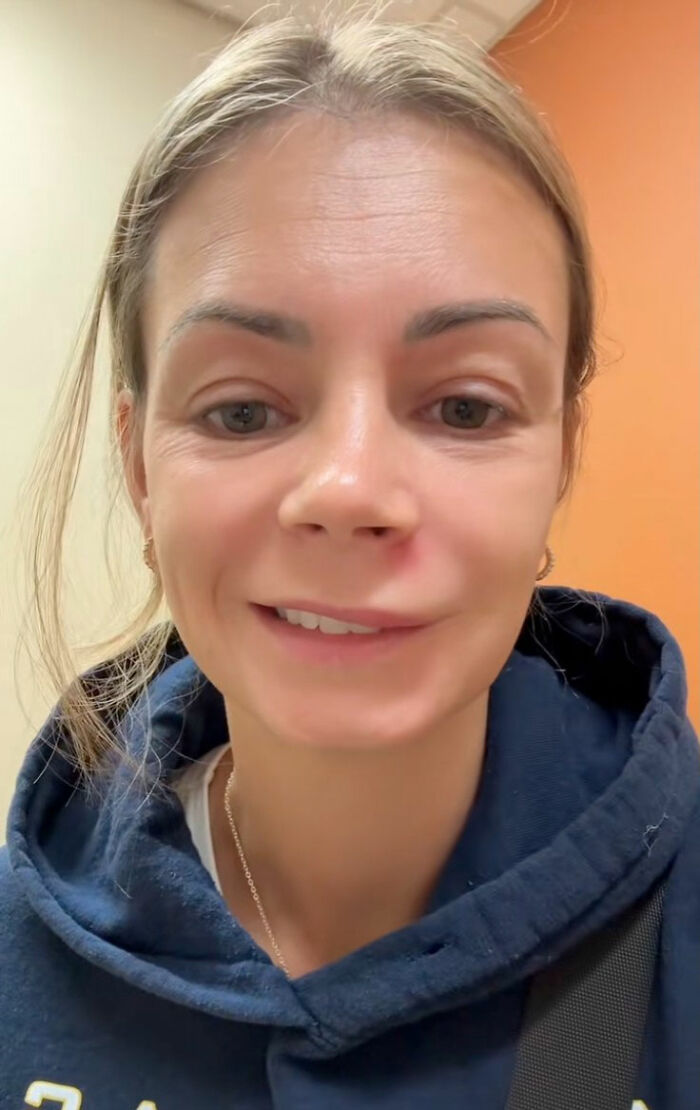 Mom Ends Up in Urgent Care After Popping Pimple In The “Triangle Of Death”