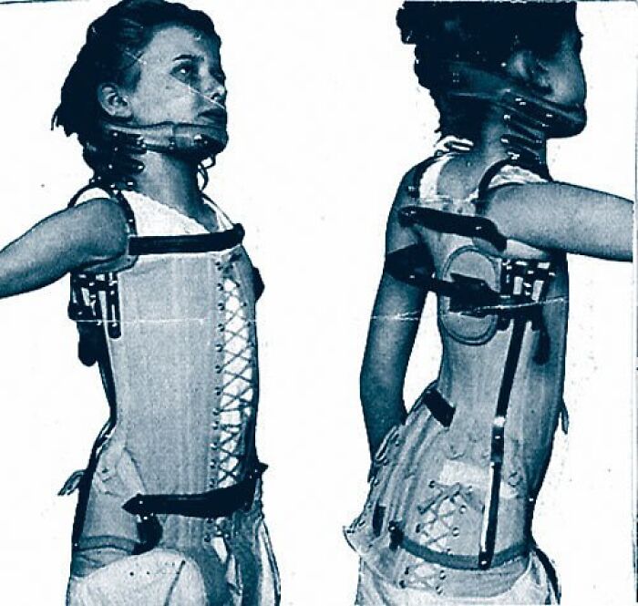 Young girl wearing a vintage medical brace with neck and back support in a weird history photo from the past.