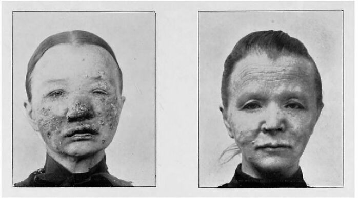 Before and after treatment of a woman with severe facial skin disease in a weird history pic showing medical conditions from the past.