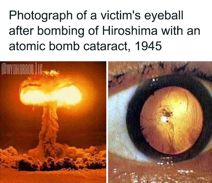 Atomic b**b mushroom cloud and victim's eyeball showing cataract caused by Hiroshima bombing, creepy facts and pics.
