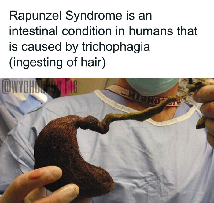 Medical professional holding a large hairball related to Rapunzel Syndrome, a creepy intestinal condition from trichophagia.