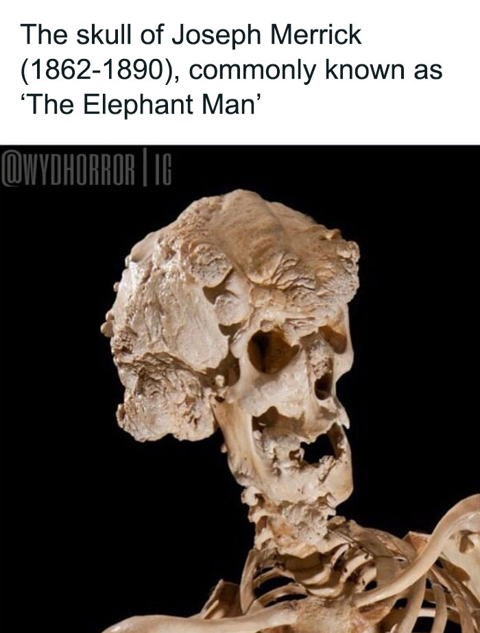 Skull of Joseph Merrick known as Elephant Man, a creepy fact featured in random creepy facts and pics collection.