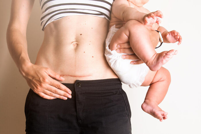 Woman showing postpartum scar holding baby, highlighting examples of everyday sexism and pressure women face.