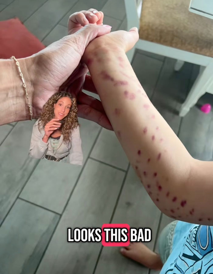 Bruised arm of 6-year-old showing marks after octopus latches onto him at aquarium, causing visible red spots and injuries.