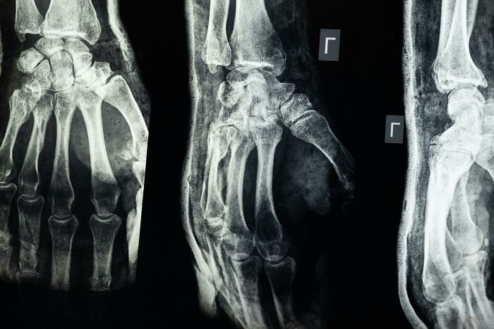 X-ray images of a fractured wrist highlighting tiny human mistakes and their impact on history and medical outcomes