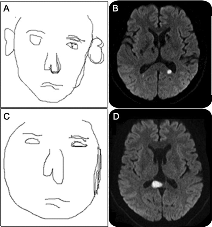 Brain scans and facial sketches illustrating a rare neurological condition causing terrifying hallucinations of dragons.
