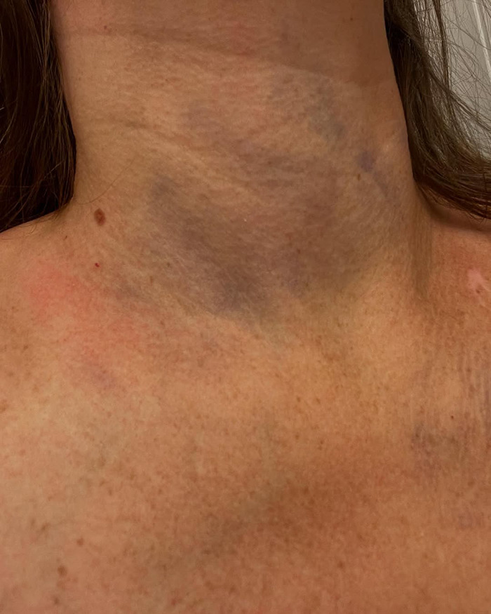 Close-up of bruised and swollen neck and chest area of Cincinnati brawl victim showing injury and skin discoloration.