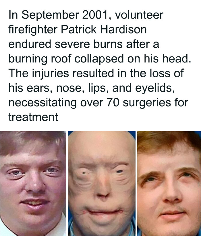 Before and after plastic surgery images of a firefighter with severe burns, illustrating creepy facts and transformations.