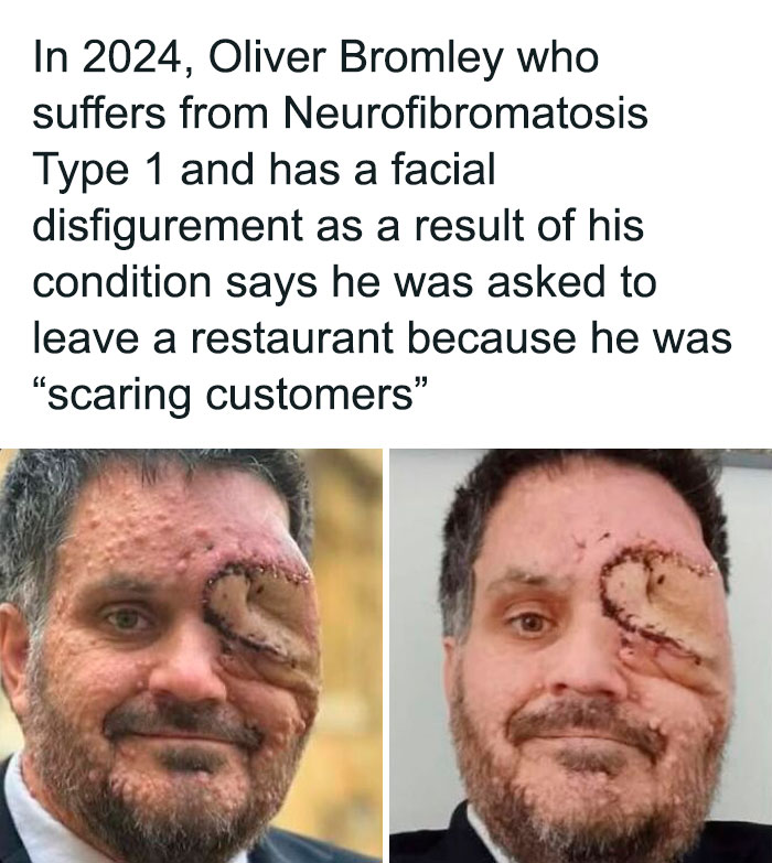 Man with Neurofibromatosis Type 1 facial disfigurement shares story in creepy facts collection to deprive sleep.
