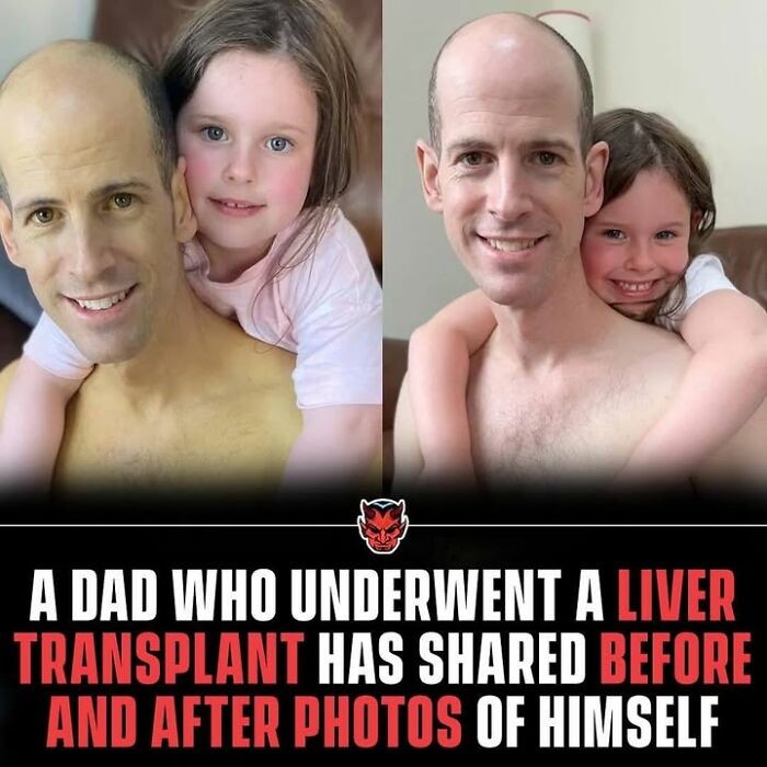 Before and after photos of a dad who underwent a liver transplant, featured in creepy facts and pictures collection.