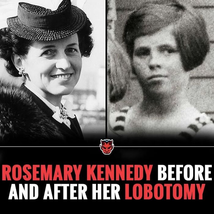 Black and white photos showing Rosemary Kennedy before and after her lobotomy, a creepy and unsettling historical fact.