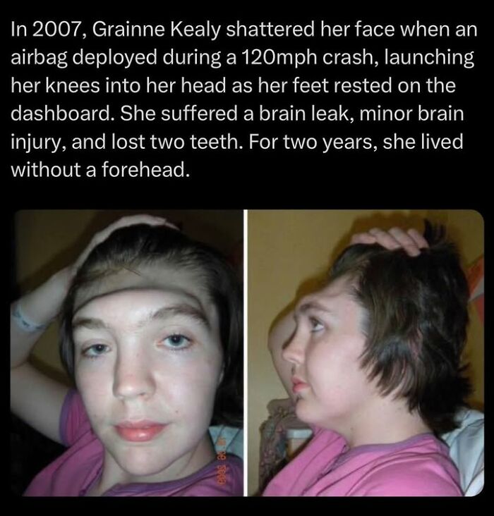 Close-up photos of a woman who lost her forehead due to a severe injury, featured in creepy facts and pictures.