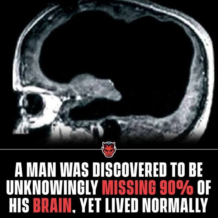 MRI scan showing a man missing 90% of his brain, a creepy fact illustrating unusual brain function and resilience.
