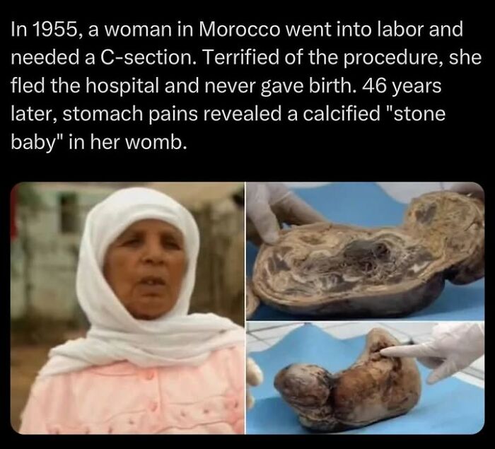 Woman in Morocco survived childbirth fears, later discovered a calcified stone baby in her womb, part of creepy facts and pictures.