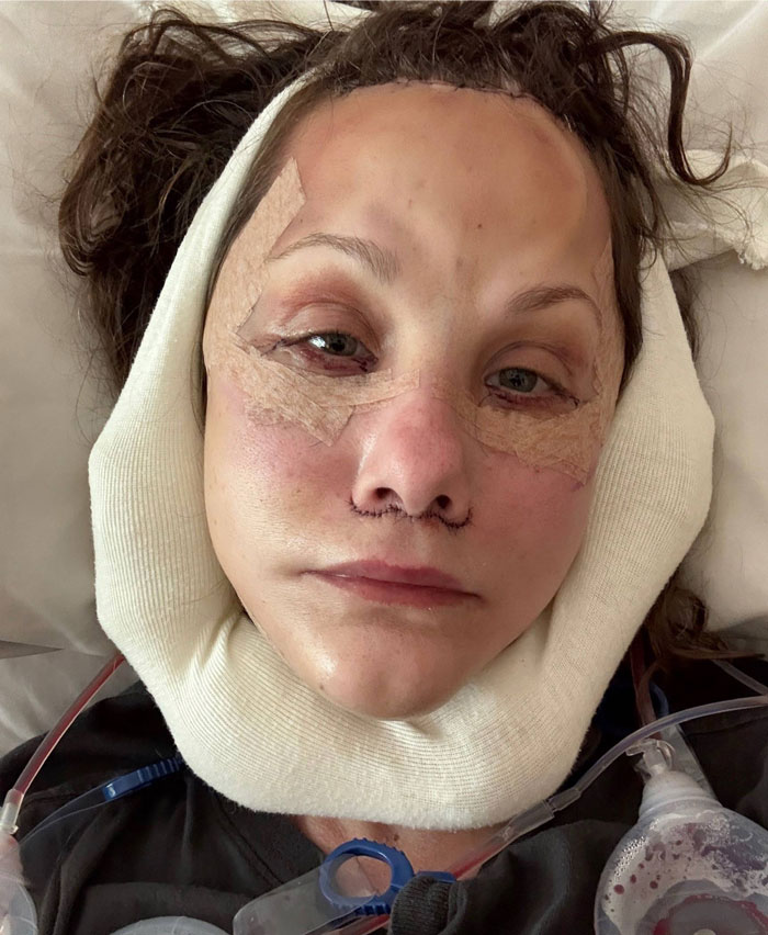 51-year-old woman resting after a face lift procedure with bandages and medical tubes showing her radical glow up. 51-year-old woman resting after a face lift procedure with bandages and medical tubes showing her radical glow up.