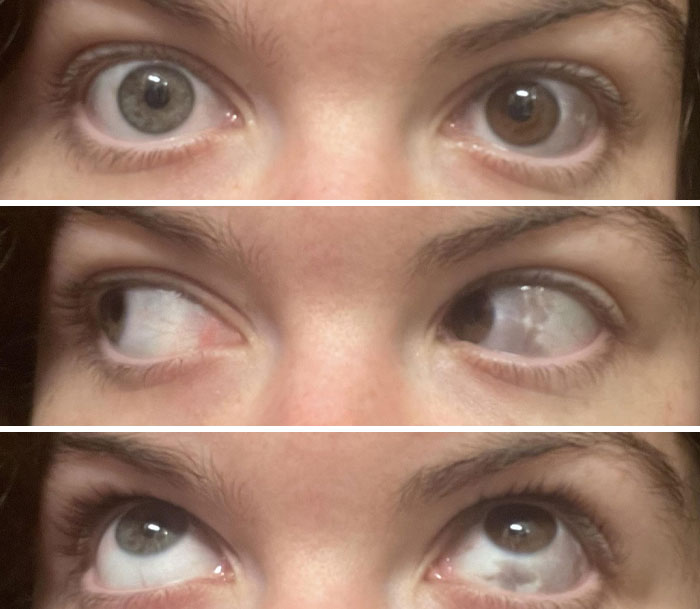 Close-up shots of eyes showing an interesting birth mark on the white part of the eye in different directions.