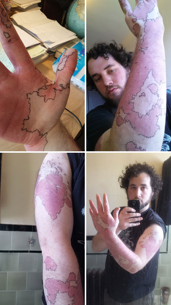 Man showing large birth marks outlined in black ink on his hand and arm in multiple photos indoors