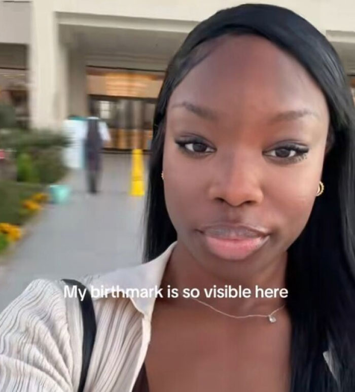 Young woman with a visible birthmark on her chest, sharing her unique and interesting birth marks in a casual setting.