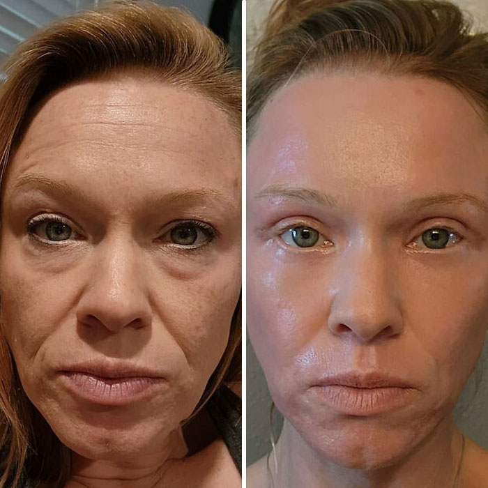 Before and after plastic surgery transformation showing facial rejuvenation and smoother skin in a Beverly Hills housewife.