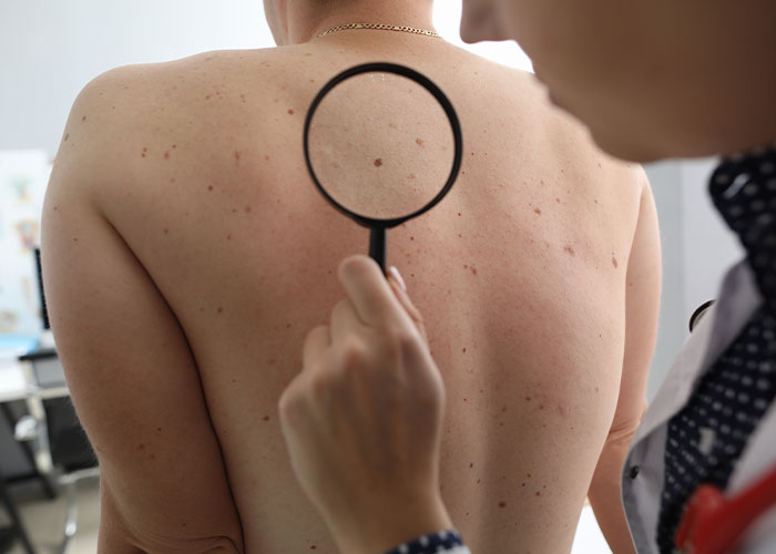 Doctor examining skin with a magnifying glass, revealing details of skin condition witnessed at work by employees