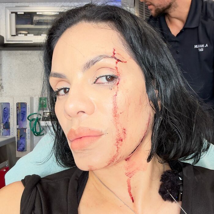 Woman with facial injuries and blood on her face after SUV crashing into couple inside a restaurant.