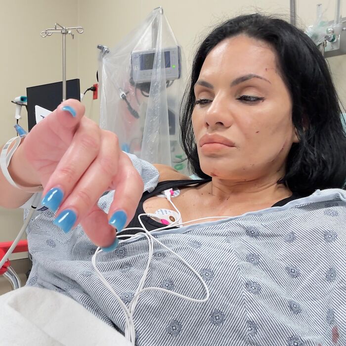 Woman with facial injuries lying in hospital bed receiving treatment after SUV crash at restaurant incident.