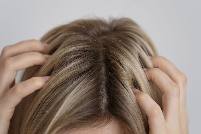 Close-up of a person’s scalp with visible dandruff, illustrating a gross and unexpected sight in strangers’ homes.