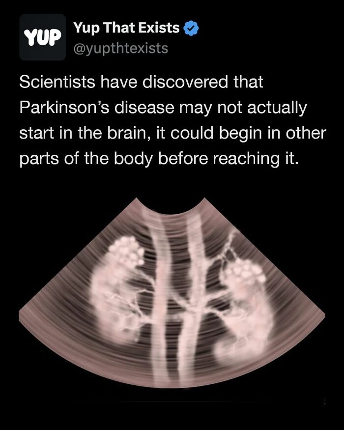 Tweet from Yup That Exists about Parkinson’s disease possibly starting outside the brain, with an ultrasound image of kidneys.