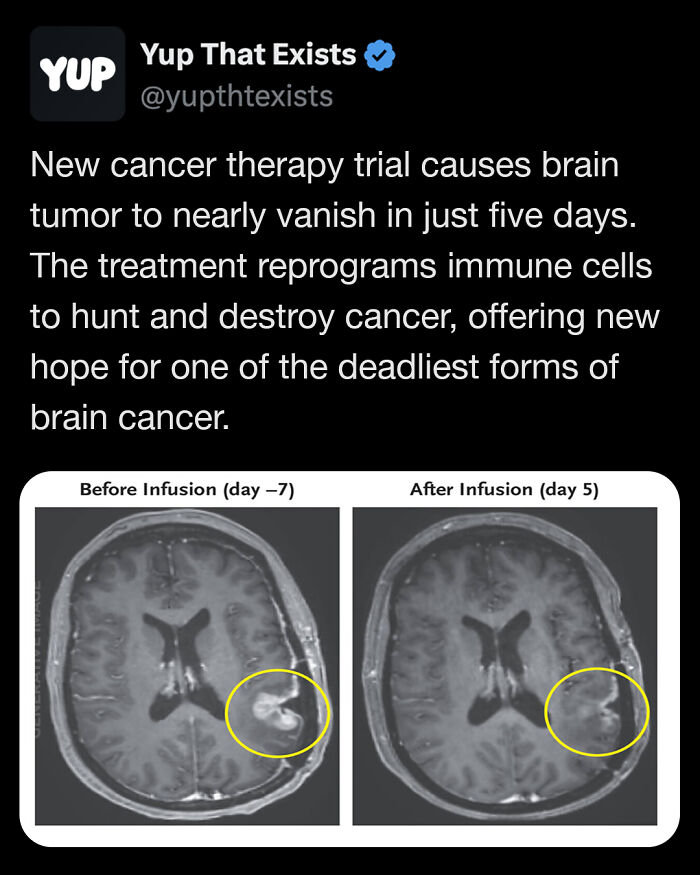 MRI scans showing brain tumor shrinkage after new cancer therapy infusion over five days from Yup That Exists post.