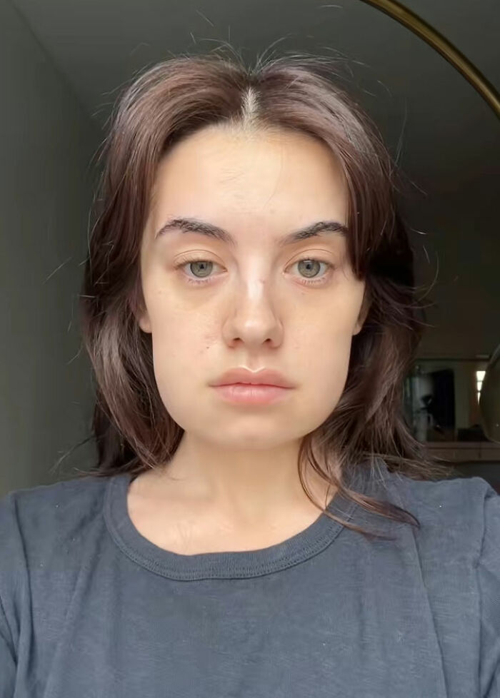 Young woman showing clear skin and natural look after Kybella face treatment during her recovery phase at home. Young woman showing clear skin and natural look after Kybella face treatment during her recovery phase at home.