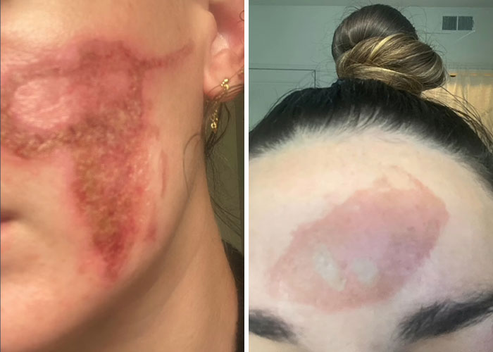 Close-up images of a woman's face showing severe skin damage allegedly caused by a celebrity facialist treatment.