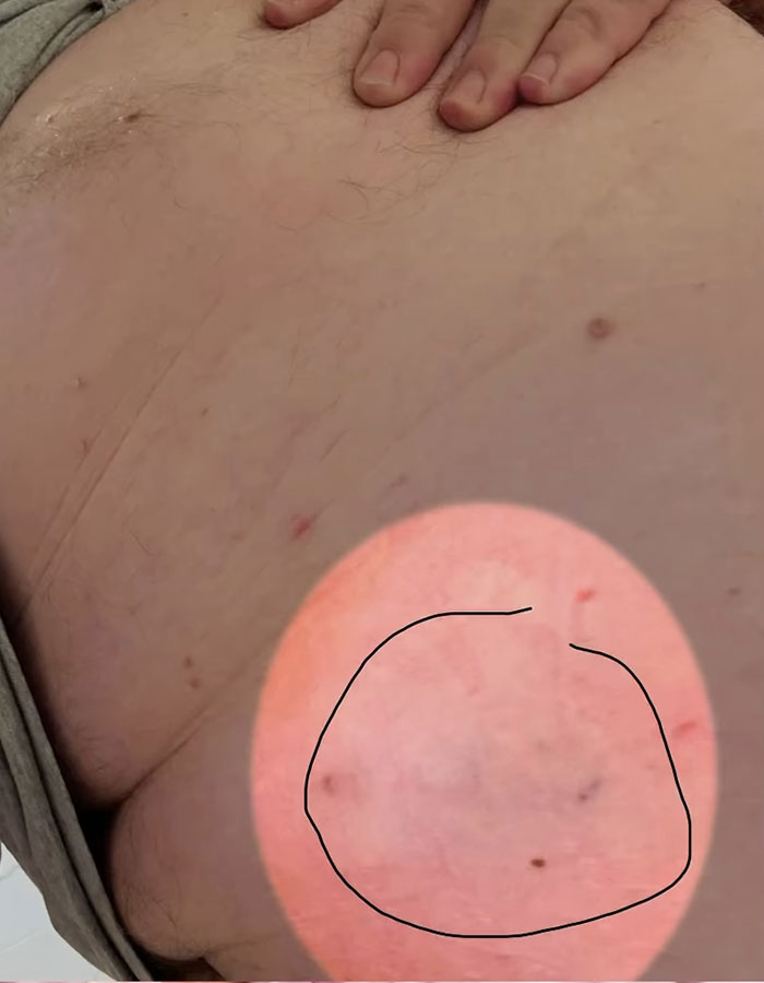 Close-up of a plus-size passenger's skin showing a red mark with a hand resting on the chest area. Close-up of a plus-size passenger's skin showing a red mark with a hand resting on the chest area.