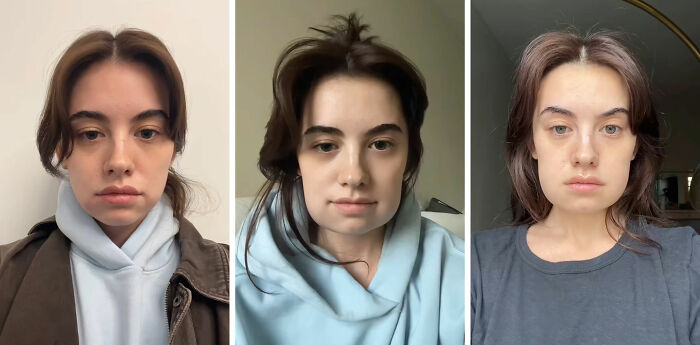 Woman's Kybella face transformation showing progress during extreme recovery phase in a series of three photos. Woman's Kybella face transformation showing progress during extreme recovery phase in a series of three photos.