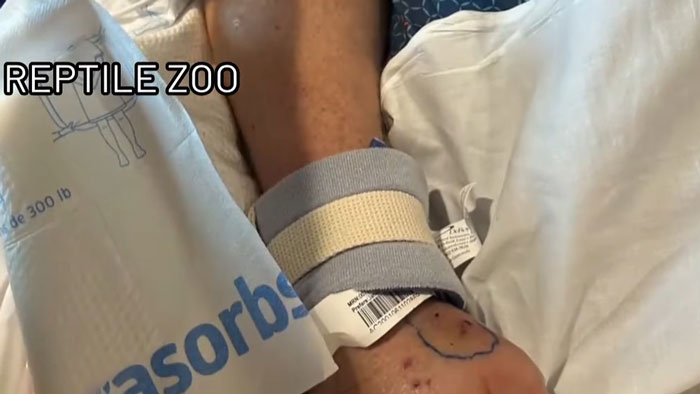 Close-up of a snakebite victim's wrist with medical bandages and an ID bracelet at a reptile zoo. Close-up of a snakebite victim's wrist with medical bandages and an ID bracelet at a reptile zoo.