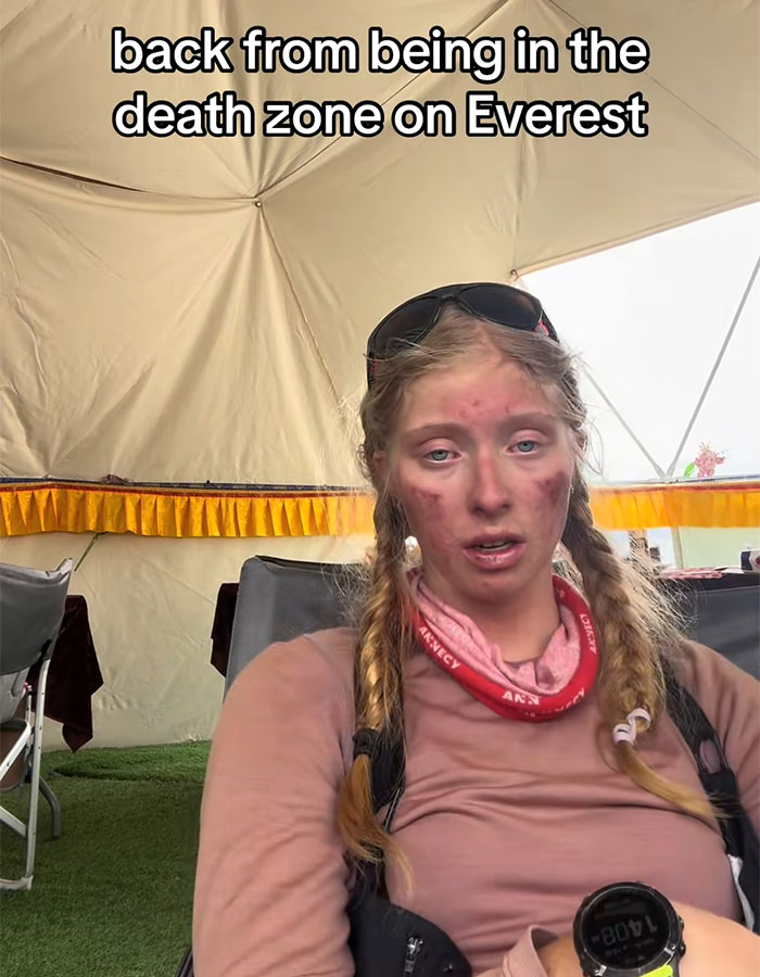 Teen with injuries and dirt on face recovering after severe Everest climb, sparking debate on climbing risks and safety concerns. Teen with injuries and dirt on face recovering after severe Everest climb, sparking debate on climbing risks and safety concerns.