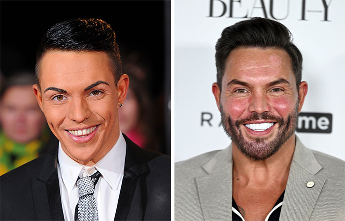 Two men smiling at events, highlighting facial features related to buccal fat removal in celebrities.