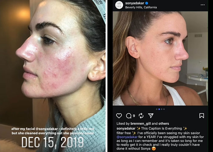 Side-by-side comparison of a woman&rsquo;s skin before and after $90,000 facial repairs by celebrity facialist.