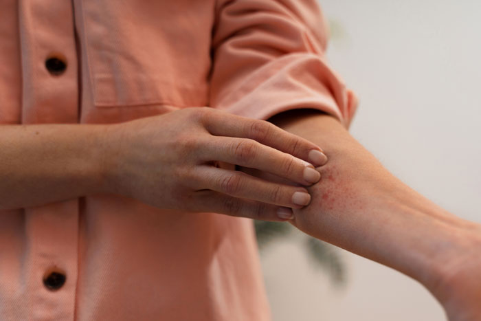 Close-up of a teen scratching an allergic reaction rash on their arm after eating at a friend’s house. Close-up of a teen scratching an allergic reaction rash on their arm after eating at a friend’s house.